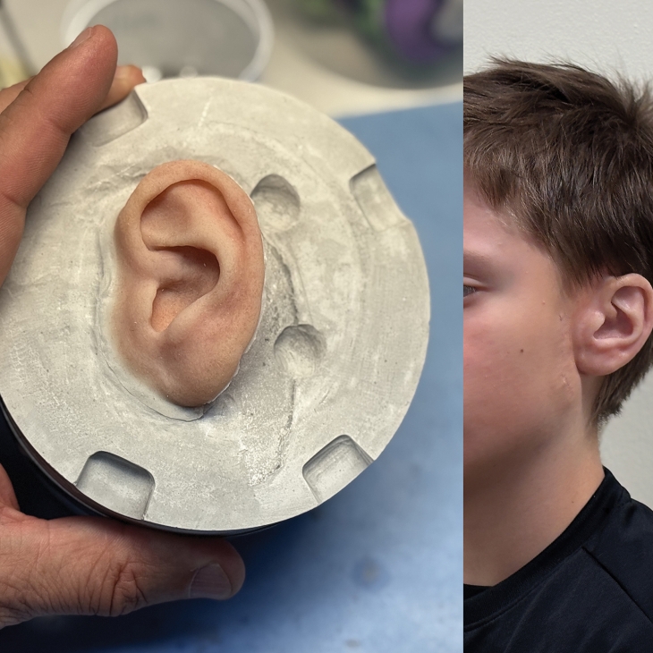 Development and Fabrication of a Magnet-Retained Auricular Epithesis within an Interdisciplinary Project for a Patient with Grade III Microtia in Estonian Context by Viktor Kiss